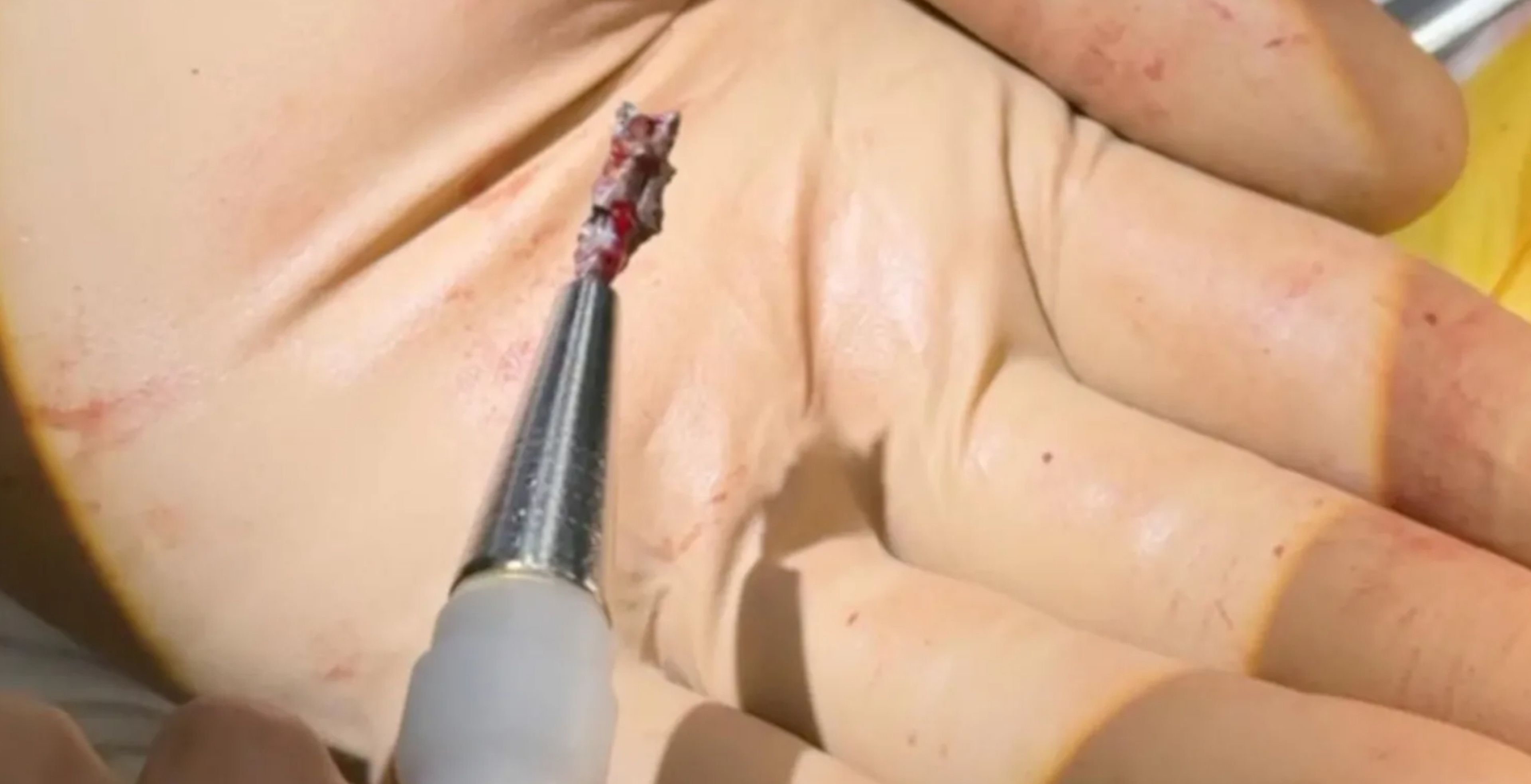 Ucrania extractor magnético heridas guerra